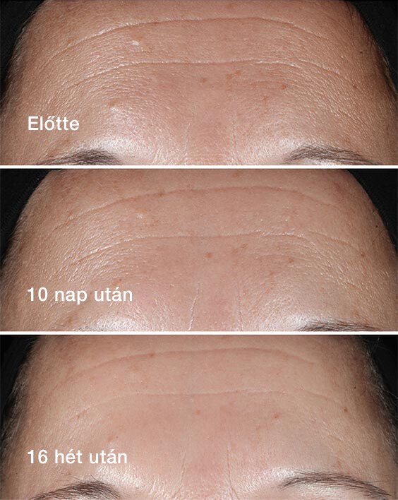 Before. After 10 days. After 16 weeks.